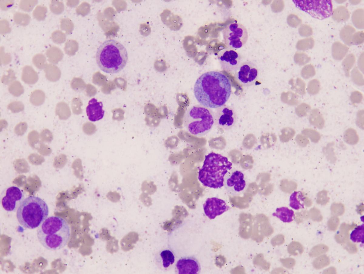 Bone marrow aspirate